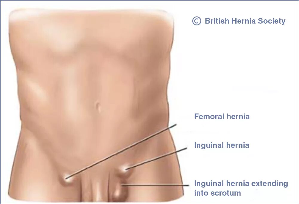 Паховая мошоночная грыжа. Мошоночно паховая грыжа у мальчика. Пахово-бедренная грыжа у мужчин.