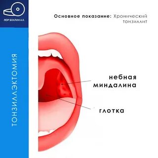 Лазерная миндалин