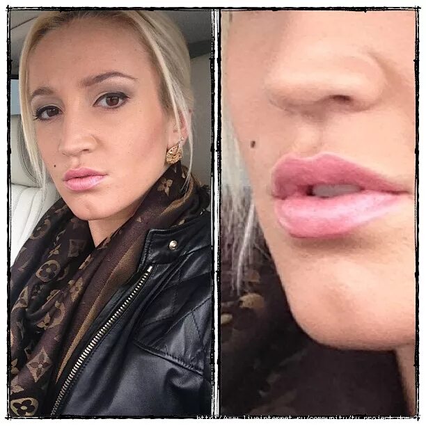 контуринг губ гиалуроновой кислотой. сделала губы форум. сделала губы форум. губы накаченные гиалуроновой кислотой 1 мл. алёна савкина либерж.