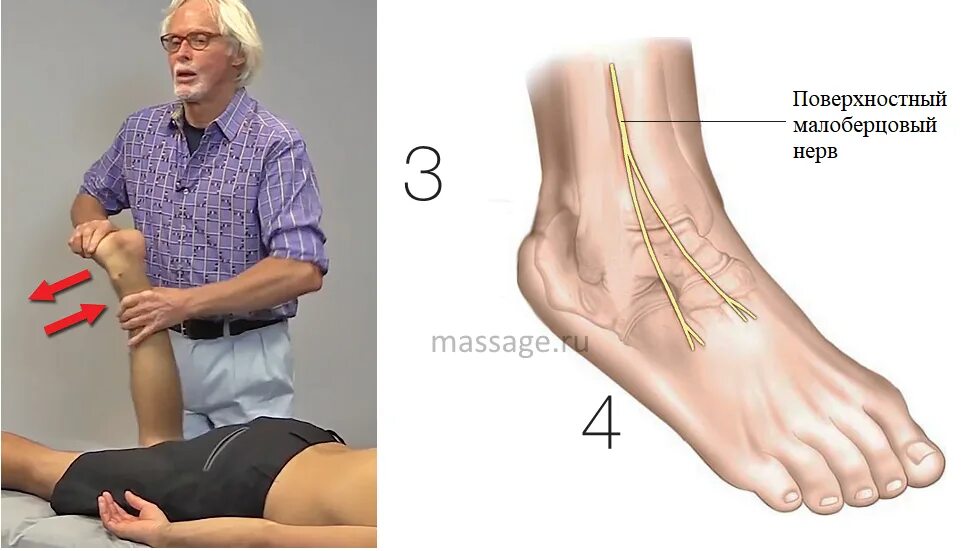 Массаж при полинейропатии. Невропатия малоберцового нерва. Парез малоберцового нерва. Нейропатия малоберцового нерва. Повреждение поверхностного малоберцового нерва.