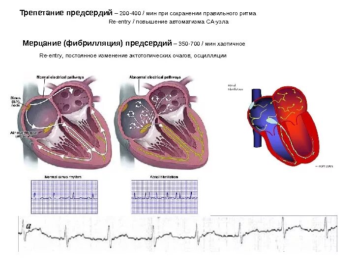Трепетание предсердий и желудочков на ЭКГ. Фибрилляция и трепетание предсердий на ЭКГ отличия. Фибрилляция и трепетание предсердий на ЭКГ. Трепетание предсердий отличие от фибрилляции предсердий. Предсердие болезни