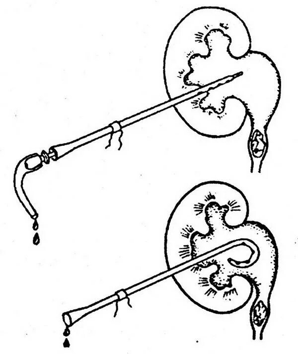 Катетеризация мочеточника. Чрескожная пункционная нефропиелостомия. Чрескожная (перкутанная) нефростомия. Нефростома чрескожная пункционная. Нефростома лоханки почки.