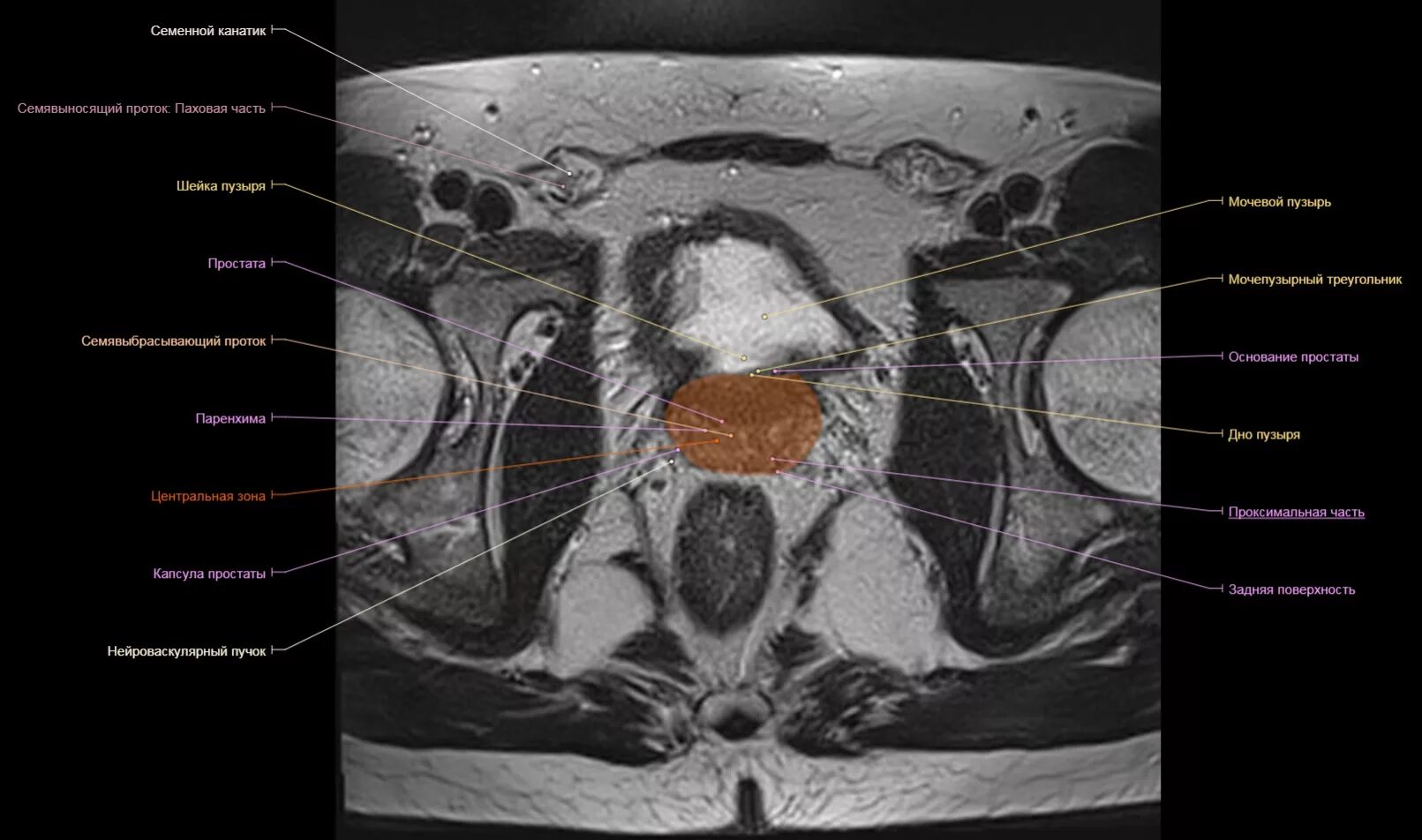 Артерии простаты. Шейка мочевого пузыря мрт анатомия. Малый таз у мужчин мрт анатомия. Анатомия мужского малого таза мрт. Трабекулярный мочевой пузырь на мрт.