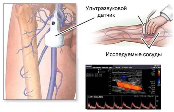 И сосудов нижних конечностей цена. Ультразвуковая допплерография артерий нижних конечностей. УЗДГ – ультразвуковая допплерография сосудов. Допплерография вен и артерий нижних конечностей что это. Ультразвуковая допплерография вен нижних конечностей.