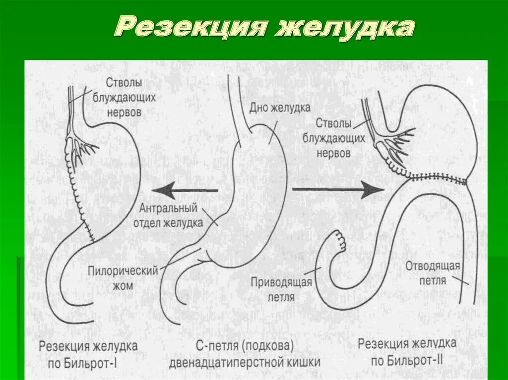 Резекция желудка Бильрот 1. Схема резекции желудка по Бильрот 1. Операция Бильрот 1 схема операции. Полное удаление желудка