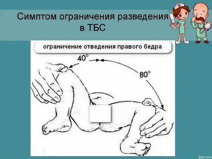 Симптомы дисплазии тазобедренных