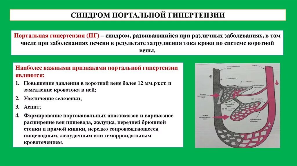 Гипертонии печень. Синдром портальной гипертензии пропедевтика внутренних болезней. Портальная гипертензия патоморфология. Синдром портальной гигипертензии. Синдром портальной гипертензии.