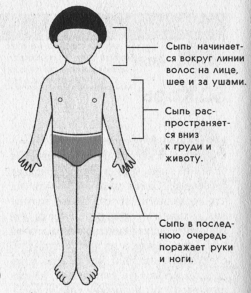 Этапность высыпаний при кори. Сроки появления сыпи при кори. Локализация высыпаний при кори. Этапность появления сыпи при кори. Локализация кори