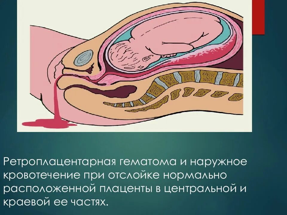 Отслойка хориона на ранних сроках. Ретроамниотическая гематома. Отслойка нормально расположенной плаценты диагностика. Отслойка нормально расположенной плаценты патогенез. Субамниотическая отслойка плаценты.