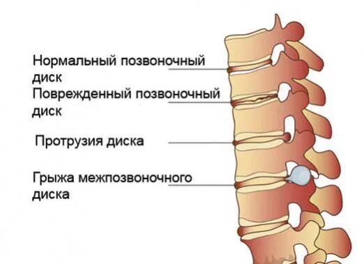 Диффузное выбухание межпозвоночного диска l3-l4. Хрящи позвоночника. Дорзальное выбухание дисков. Позвоночник диск хряща.