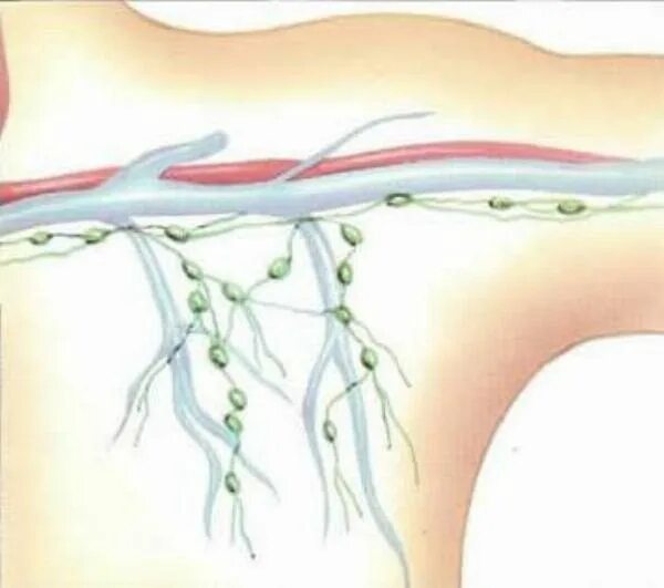 Лимфоузлы и удаление матки. Подмышечные лимфоузлы воспаление. Воспалённые подмышечные лимфоузлы. Воспаленные лимфоузлы подмышками. Лимфоотток в подмышечные лимфоузлы.