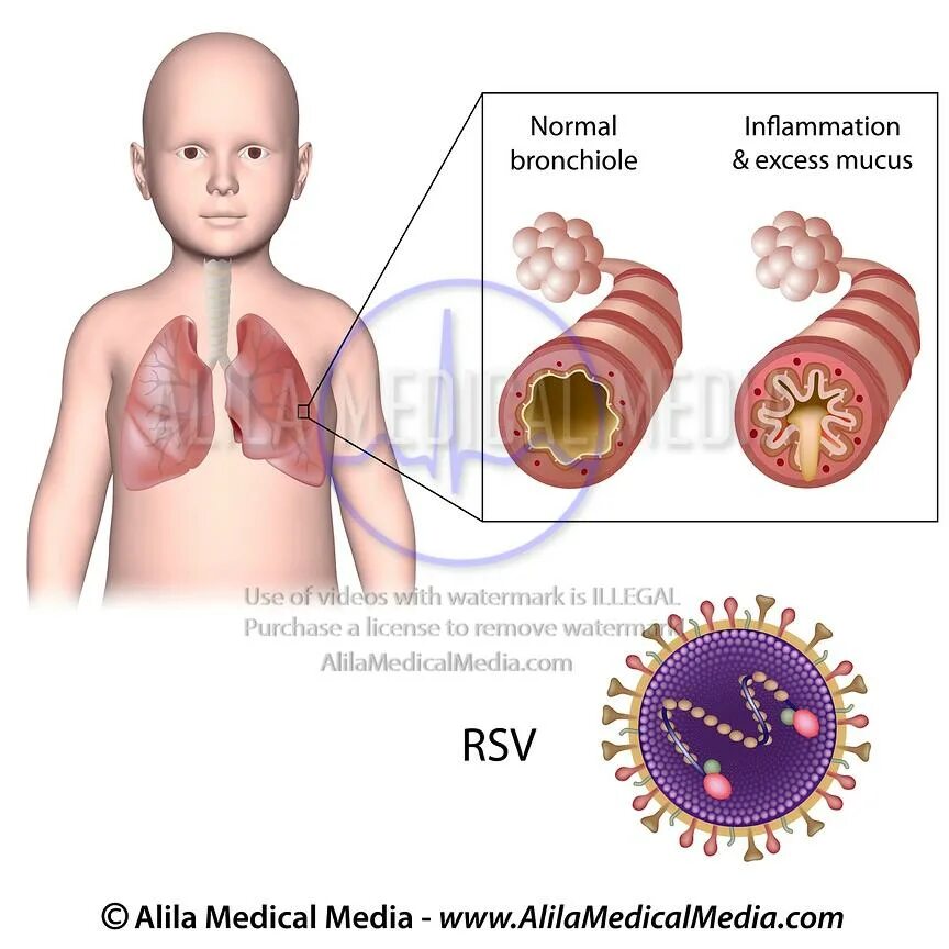 Syncytial virus. Симптомы респираторно синцитиальной инфекции. Респираторно-синцитиальный вирус человека. Респираторно-синцитиальная инфекция у детей. РС инфекция у детей.