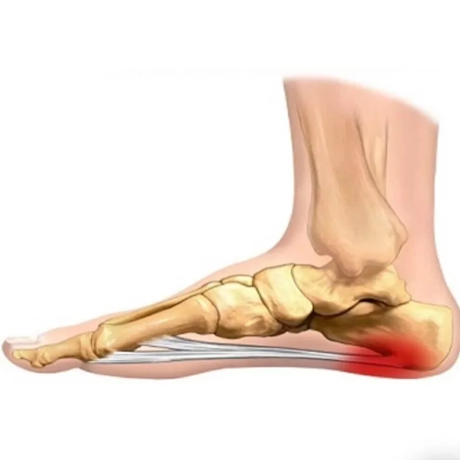 пяточная кость рентген перелом. перелом пяточной кости перевязка. сломана пятка ноги. рентген снимок перелом кубовидной кости стопы. перелом лодыжки лонгета.
