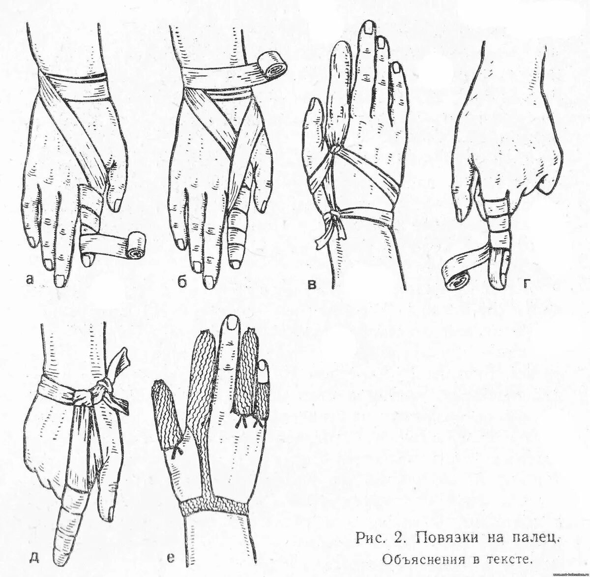 Повязка на руку схема. Схема перевязки большого пальца на руке. Наложение бинтовой повязки на палец. Перевязка кисти бинтом. Схема бинтования пальца на руке.