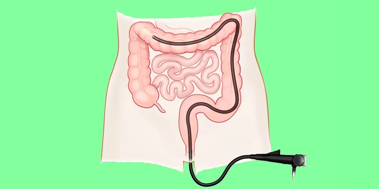 Ректальный человек. Эндоскопическое исследование толстой кишки колоноскопия. Ректоскопия кишечника. Эндоскопическое исследование Толстого кишечника. Ректороманоскопия (ректоскопия).