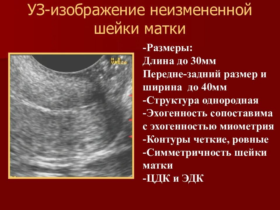 Матка сколько норма. Длина шейки матки. Матка в норме. Передне-задний размер матки. Размер шейки матки.