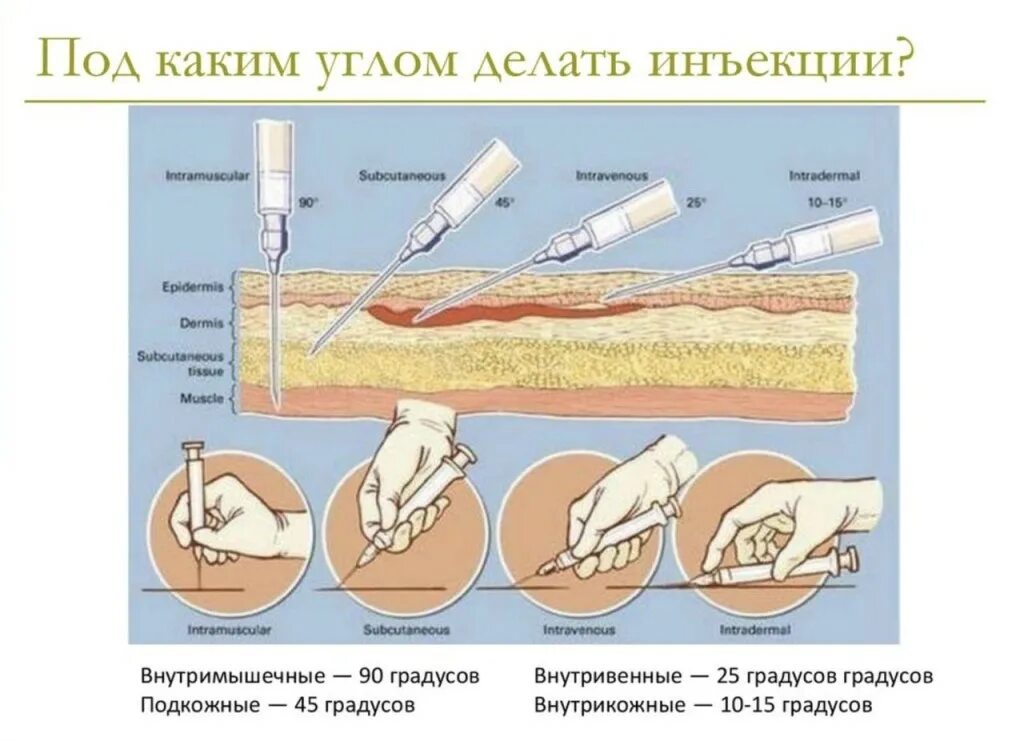 Внутрикожная инъекция угол наклона иглы. Внутримышечная инъекция угол введения иглы. Введение иглы при внутримышечной инъекции. Схема выполнения внутрикожной инъекции. Как колоть железо внутримышечно