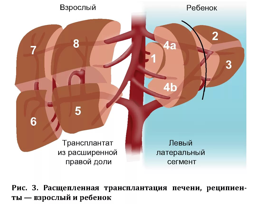 Стану донор печени. Трансплантация печени этапы. Трансплантология печени.