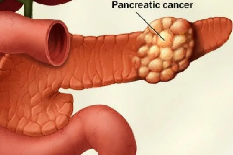 Поджелудочной железы (опухоли и панкреатит);. Карцинома поджелудочной железы. Опухла поджелудочная железа. Полип поджелудочной железы. Лечение опухоли поджелудочной