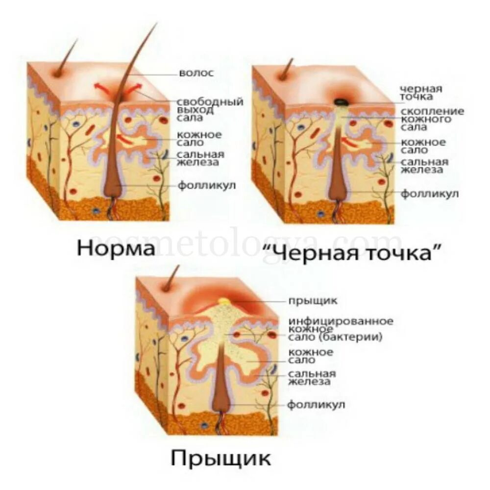Как избавиться от прыща на языке