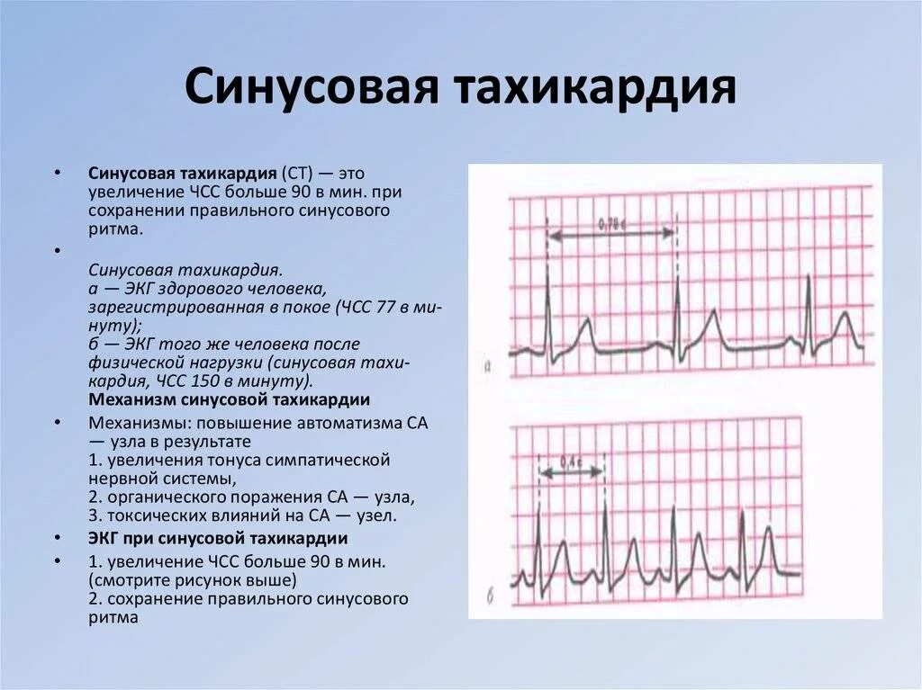 Тахикардия у ребенка 10 лет. Синусовая тахикардия экг признаки. экг патология синусовая тахикардия. экг при синусовой тахикардии сердца. экг синусовая тахикардия заключение экг.