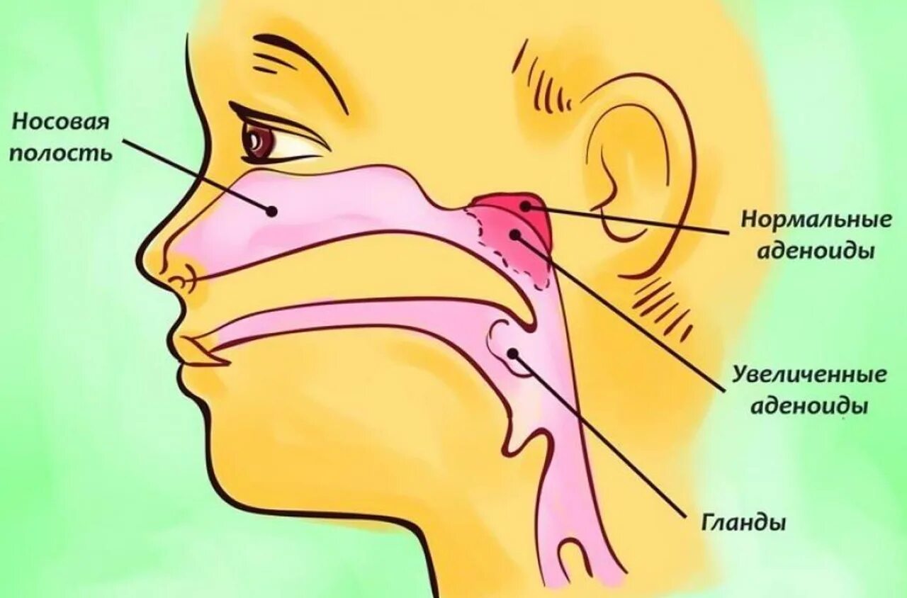 Аденоиды признаки. Аденоиды у детей анатомия. Строение горла аденоиды. Строение носоглотки аденоиды. Глоточные миндалины схема.