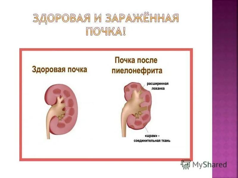 Пиелонефрит урография гидронефроз. Здоровая почка и пиелонефрит. Здоровая почка и почка с пиелонефритом.