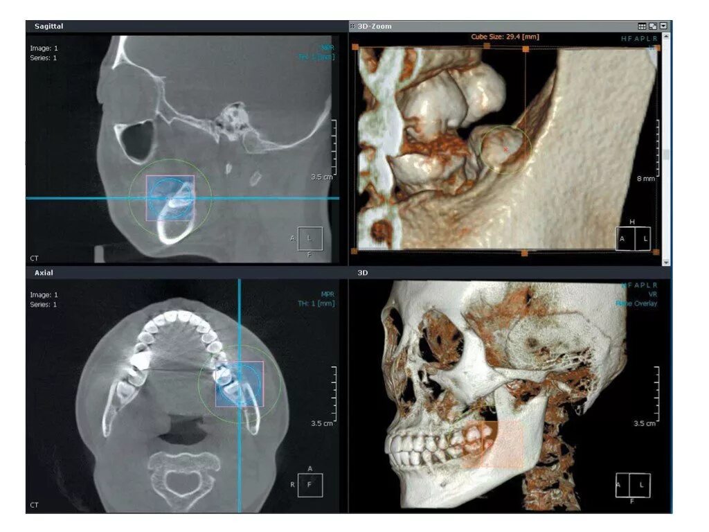 конусно-лучевая компьютерная томография внчс. артрит внчс лучевая диагностика. кт внчс в естественной окклюзии. артрит челюстного сустава на кт. кт внчс в естественной окклюзии.