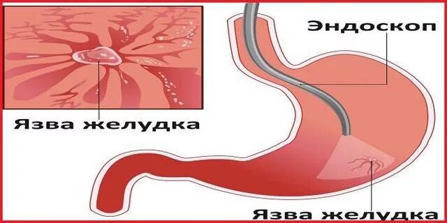 Крови и боли в желудке