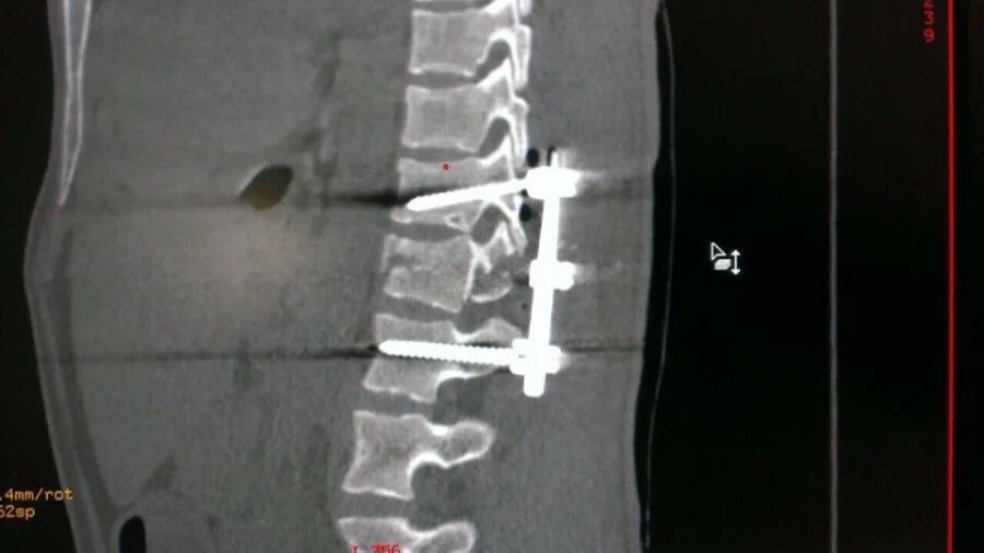 После операции на крестцовый отдел позвоночника. Остеосинтез позвоночника транспедикулярной. Транспедикулярная фиксация l1-l2-l3-l4-l5 системой. Фиксатор позвоночника передняя шейная пластина Stryker.
