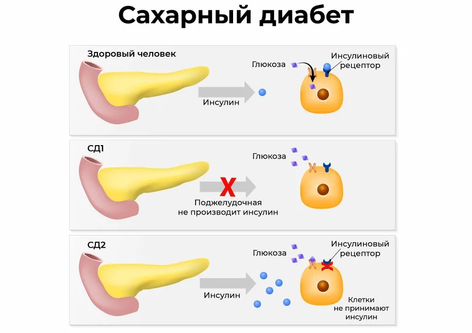 Сд 1 го типа. Сахарный диабет 1 типа поджелудочная железа. поджелудочная железа при сахарном диабете 1 типа. поджелудочная железа сахарный диабет 2 типа. признаки сд 1 типа.