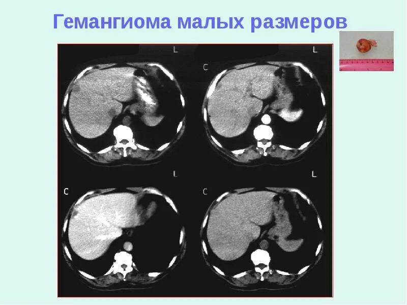 Кавернозная гемангиома печени кт. Капиллярная гемангиома печени на кт. Атипичная гемангиома печени на кт. Очаговые гемангиомы печени