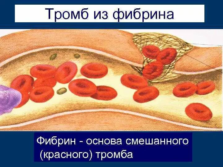 Что является тромба. Что является основой тромба.