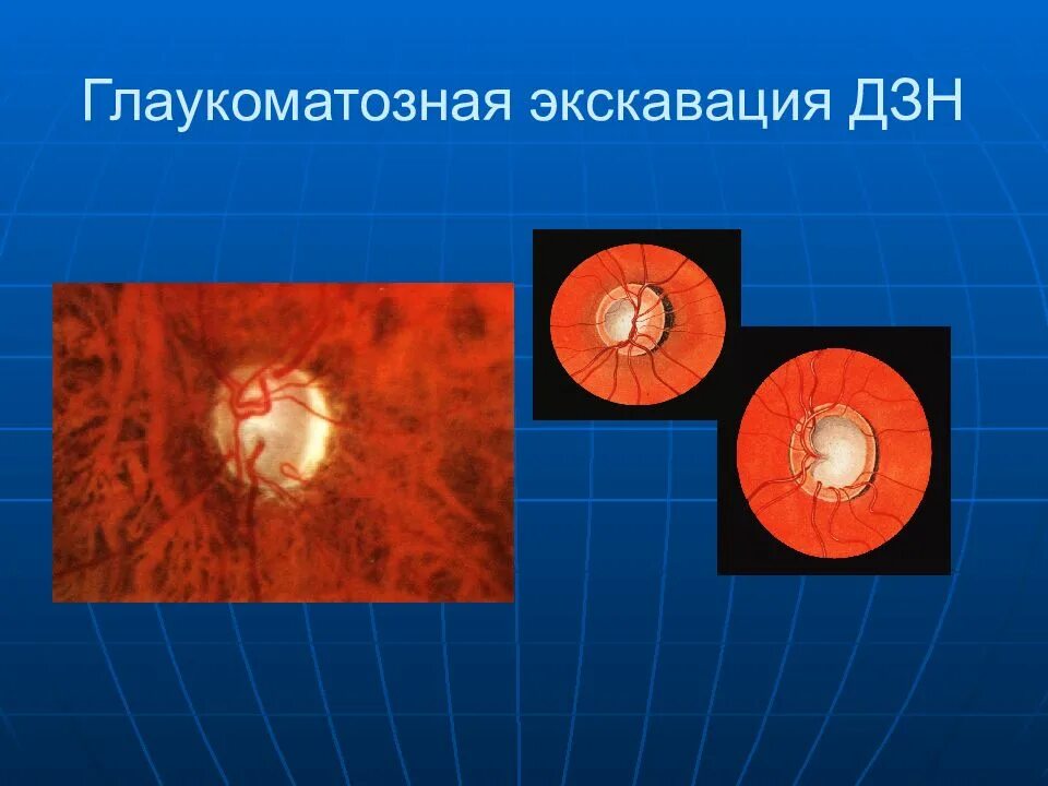 Зрительный нерв при глаукоме. Глаукоматозная экскавация ДЗН. Физиологическая экскавация диска зрительного нерва. Экскавация диска зрительного нерва 0.4. Глаукоматозная атрофия зрительного нерва.