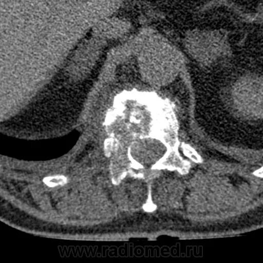 Метастазы в костях позвоночника на кт. Химиоэмболизация метастаз позвоночника. Метастазы в мягких тканях. Лучевая терапия при метастазах в кости.
