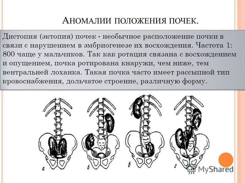 Аномалия расположения