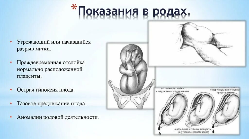 Тазовое предлежание тесты нмо. Кесарево тазовое предлежание. тазовое предлежание плода кесарево сечение.