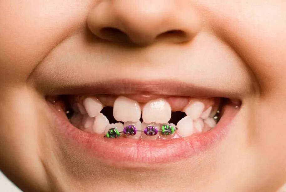 Молочные зубы картинки. Кривые зубы у дите.