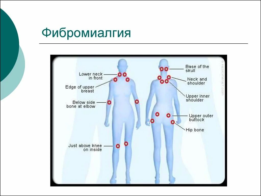 Фибромиалгия симптомы. Заболевание мышц фибромиалгия. патогенез фибромиалгии. фибромиалгия признаки. точки при фибромиалгии.
