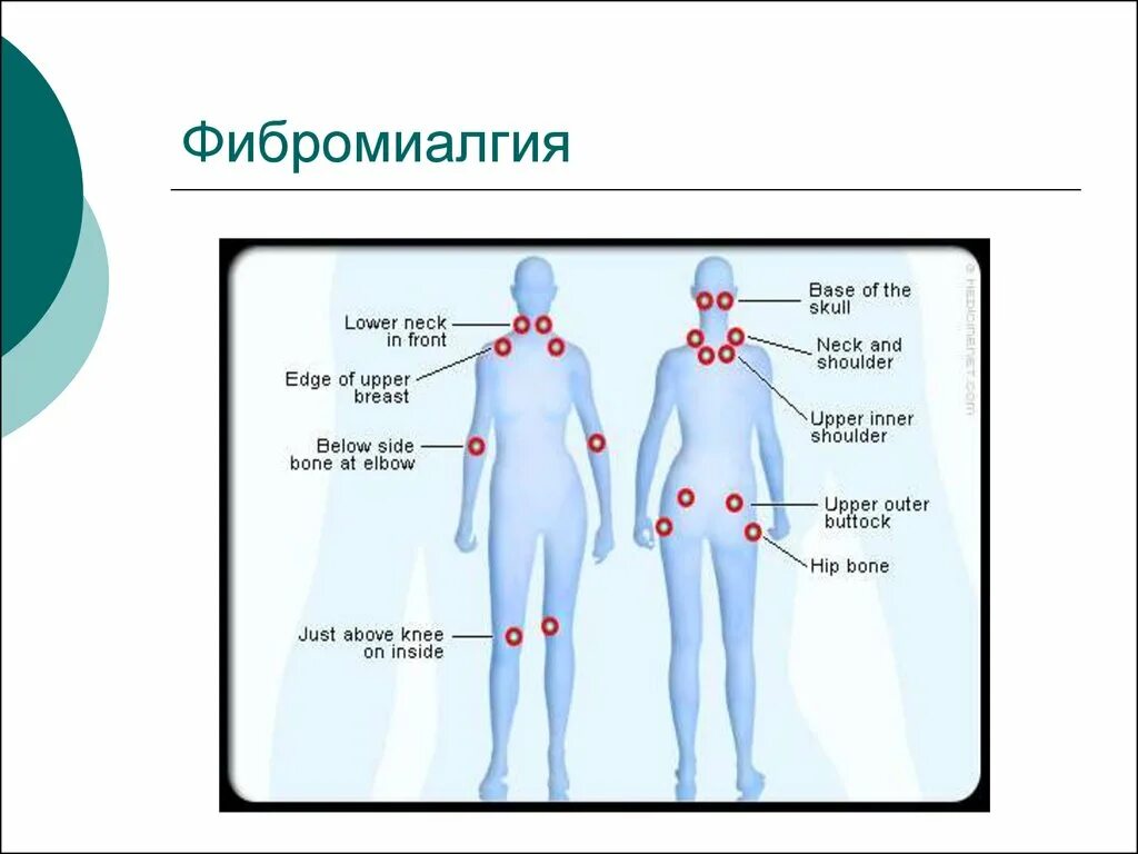 Фибромиалгия диагностические критерии. Болезнь Фибромиалгия. Симптомы фибромиалгии. Фибромиалгия что это такое как лечить. Фибромиалгия симптомы причины и лечение