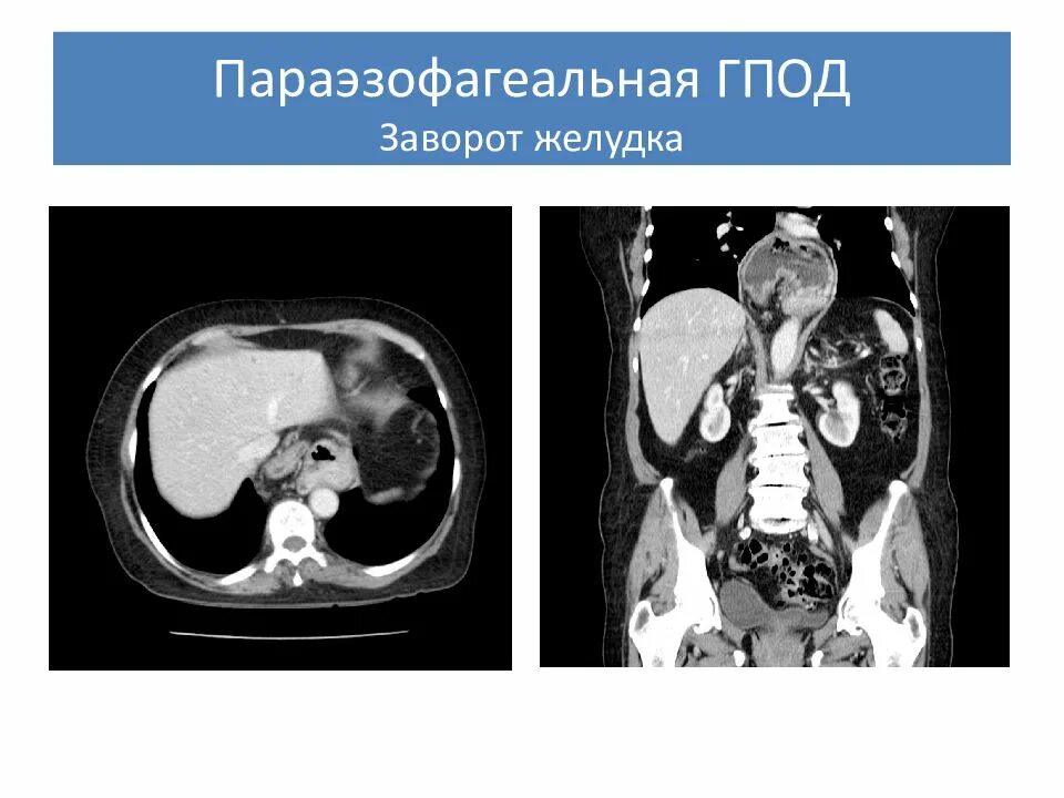 Диафрагмальная грыжа кт картина. Варикозное расширение вен пищевода кт. Параэзофагеальная грыжа пищеводного отверстия диафрагмы кт. Грыжа диафрагмы на кт брюшной полости. Аксиальная грыжа пищеводного отверстия диафрагмы на кт.