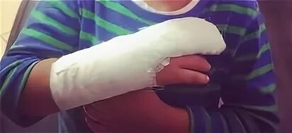Гипс на безымянном пальце