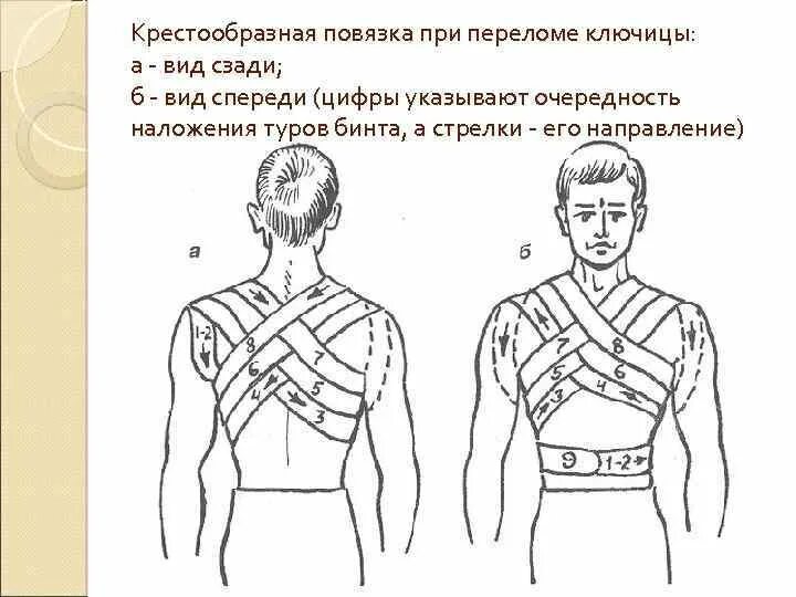 Крестообразная повязка. Повязка Дезо при переломе ребер. Дезо повязка техника спереди и сзади. Наложение восьмиобразной повязки на грудную клетку. Дезо при переломе ключицы вид сзади.