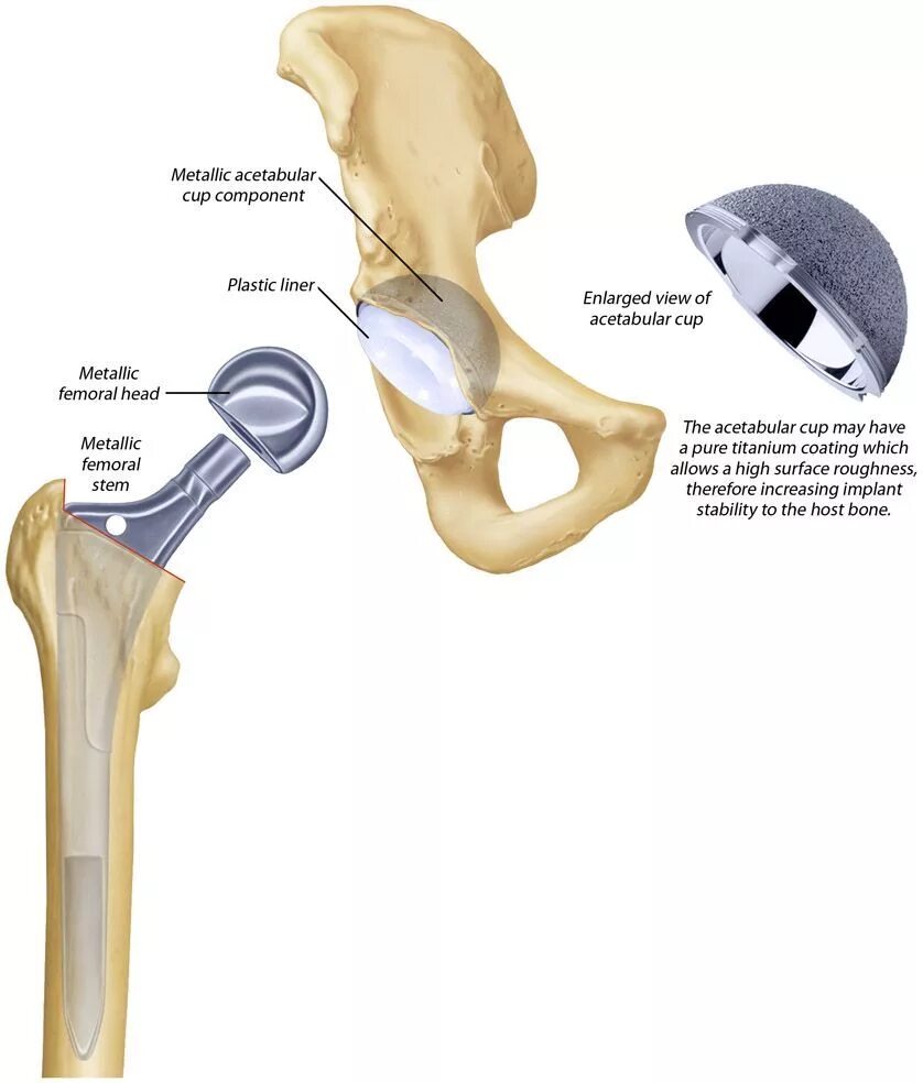 Замена тазобедренного сустава сроки восстановления. Схема эндопротезирования тазобедренного сустава. Эндопротез тазобедренного сустава строение. Части протеза тазобедренного сустава. Протез тазобедренный сустав тазобедренного сустава.