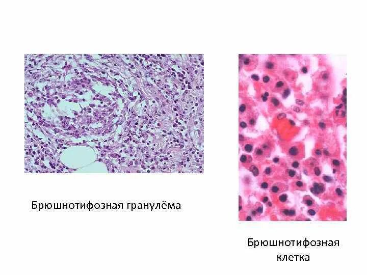 Гранулема это патанатомия. Гранулема брюшного тифа микропрепарат. Брюшнотифозная гранулема микропрепарат.