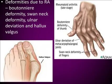 Polyarthritis латынь