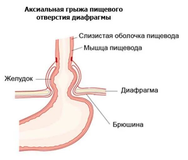 Кардиальная грыжа пищеводного отверстия. Грыжа пищеводного отдела диафрагмы степени. Фундальная грыжа пищеводного отверстия диафрагмы. Грыжа пищеводного отверстия причины