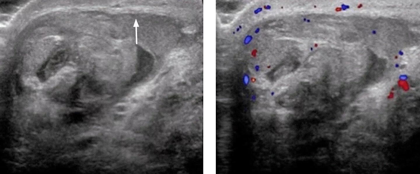 Абсцесс придатка яичка УЗИ. Перекрут придатка яичка УЗИ.