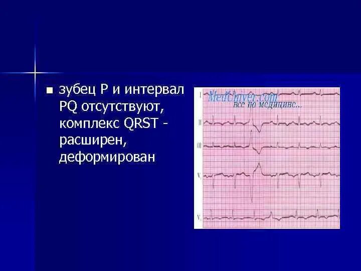 Деформированный зубец р. Деформированный зубец p. зубец p отсутствует. отсутствие интервала pq на экг. деформация комплекса qrst.