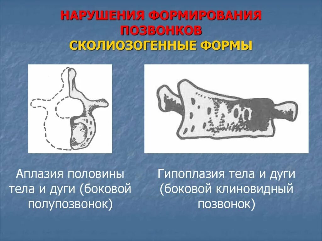 Аномалии развития позвонков. Нарушение формирования позвонков. Аномалии развития тел позвонков. Аномалии развития шейных позвонков.